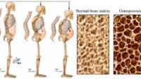 Osteoporosis: Ancaman Senyap Bagi Kesehatan Tulang