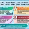 Tips Merawat Kulit Kepala Agar Terbebas Dari Masalah Ketombe Yang Sangat Mengganggu